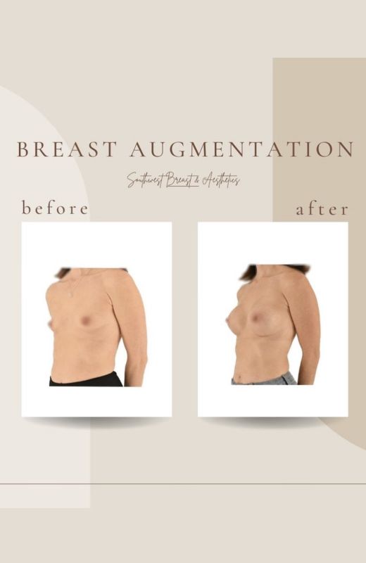 Breast augmentation before and after comparison images.