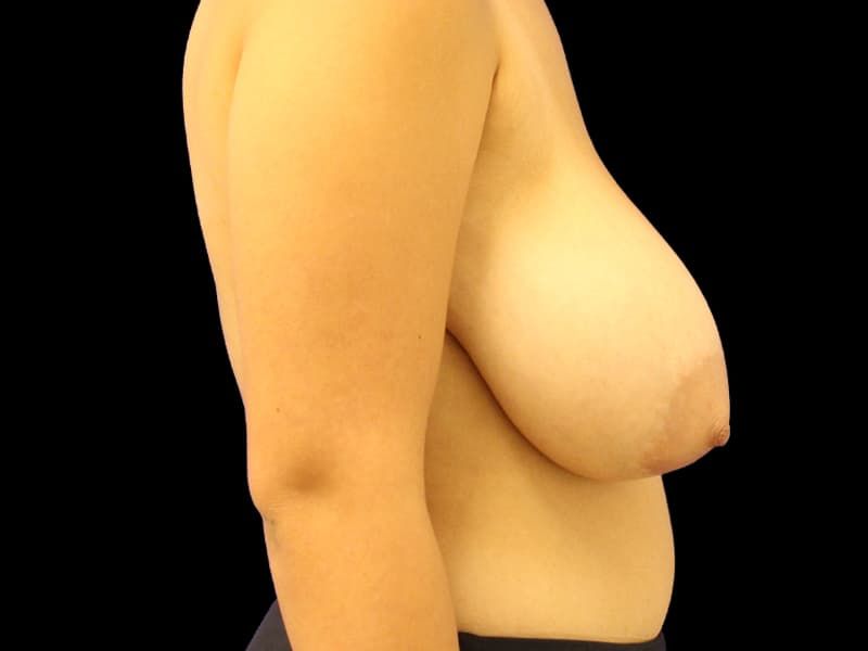 Breast Reduction with Lift Before & After