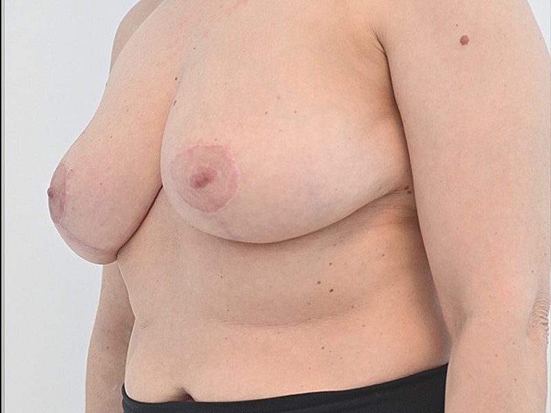 Breast Reduction with Lift Before & After