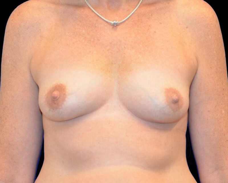 Breast Fat Grafting Before & After
