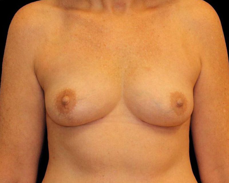 Breast Fat Grafting Before & After