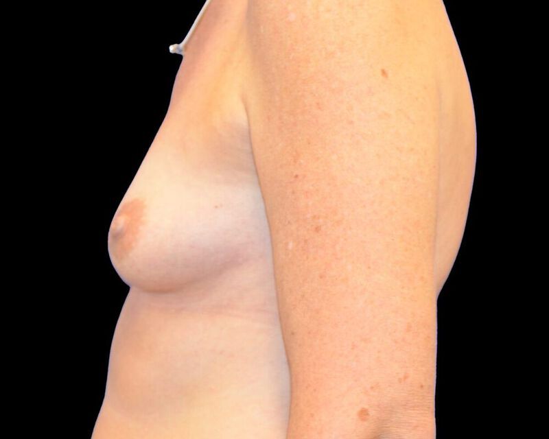 Breast Fat Grafting Before & After