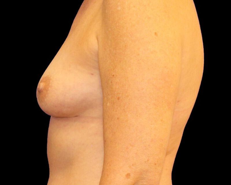 Breast Fat Grafting Before & After