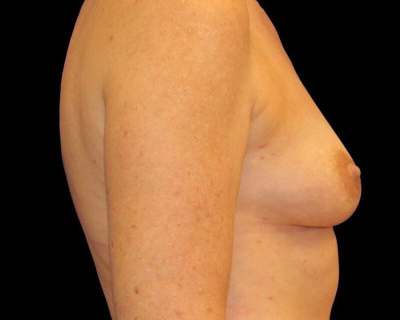 Breast Fat Grafting Before & After