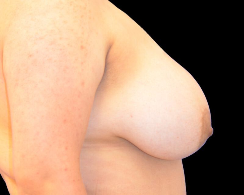 Breast Implant Before & After