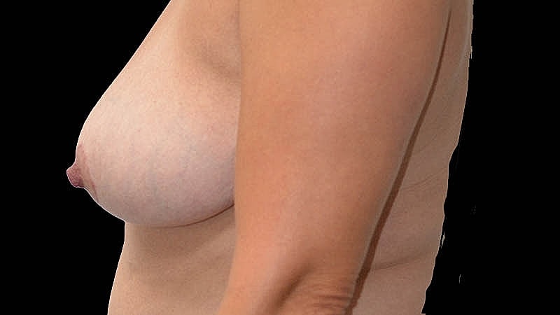 Breast Implant Before & After