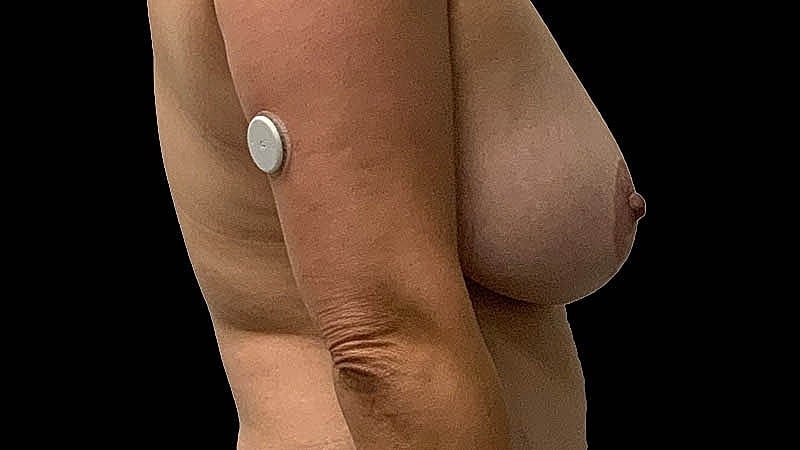 Breast Implant Before & After