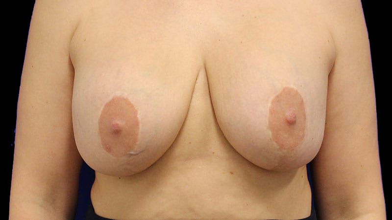 Breast Implant Removal Mastiopexy Before & After