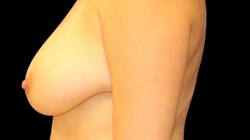 Breast Implant Removal Mastiopexy Before & After