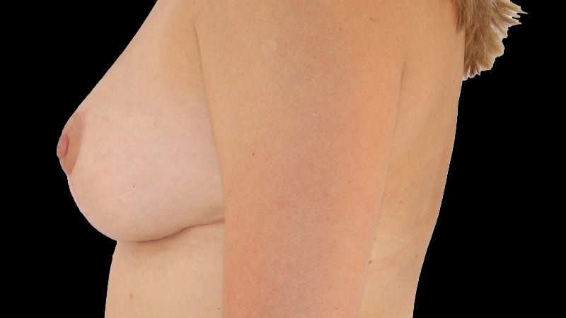 Breast Implant Removal Mastiopexy Before & After