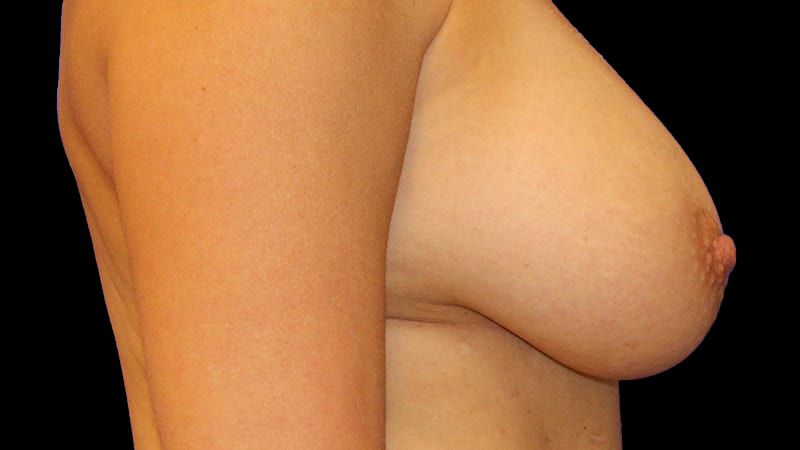 Breast Implant Removal Mastiopexy Before & After
