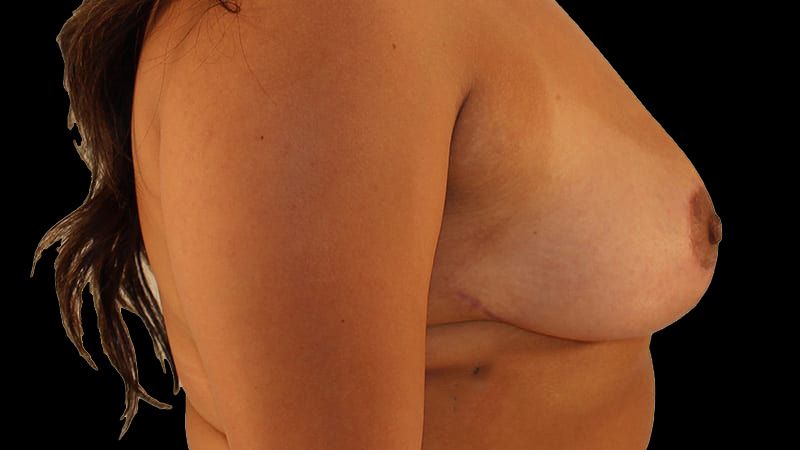 Breast Implant Removal Mastiopexy Before & After