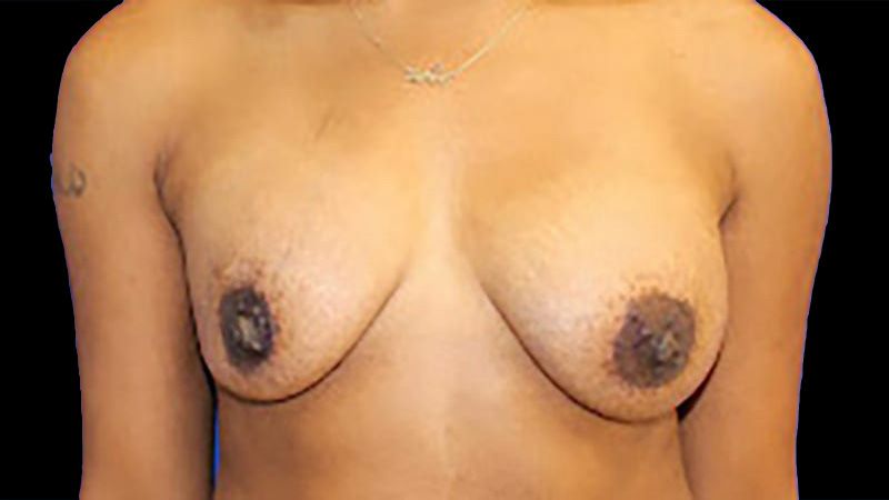 Breast Implant Removal Mastiopexy Before & After