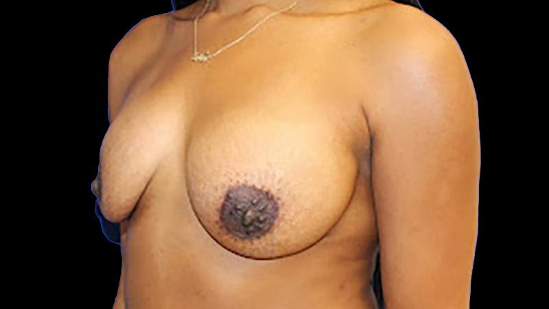 Breast Implant Removal Mastiopexy Before & After