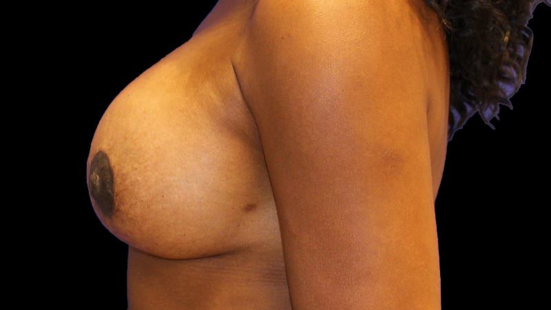 Breast Implant Removal Mastiopexy Before & After
