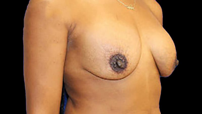 Breast Implant Removal Mastiopexy Before & After