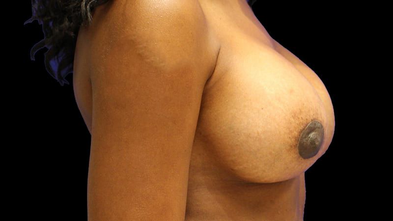Breast Implant Removal Mastiopexy Before & After