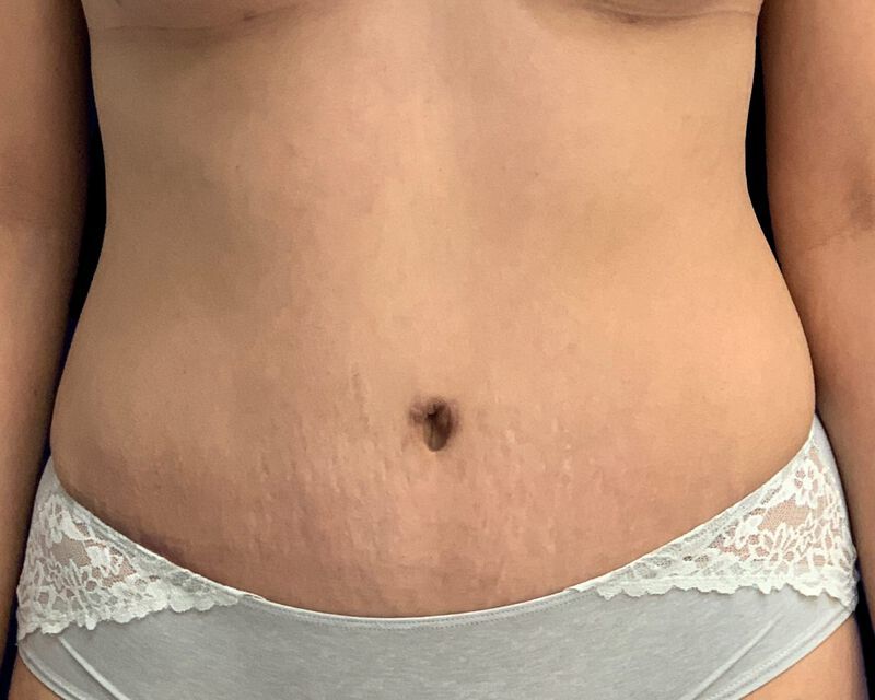 Tummy Tuck Before & After