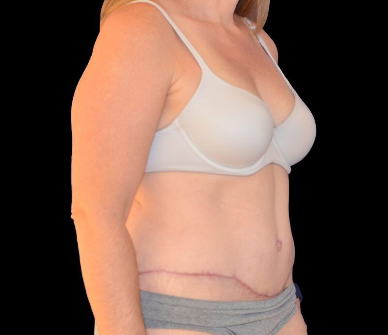 Tummy Tuck Before & After