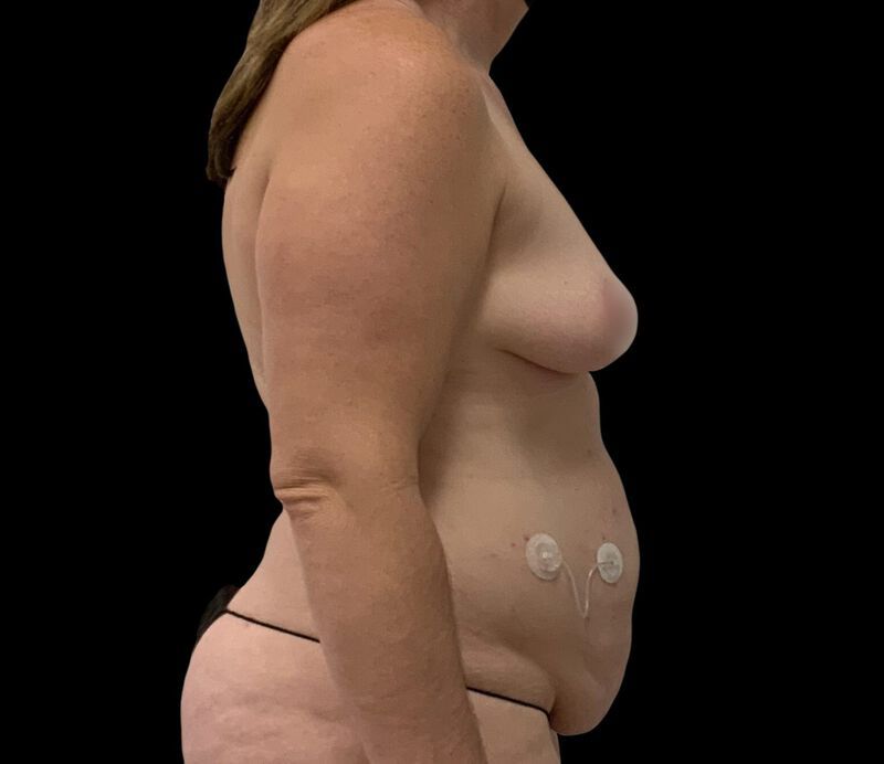 Tummy Tuck Before & After