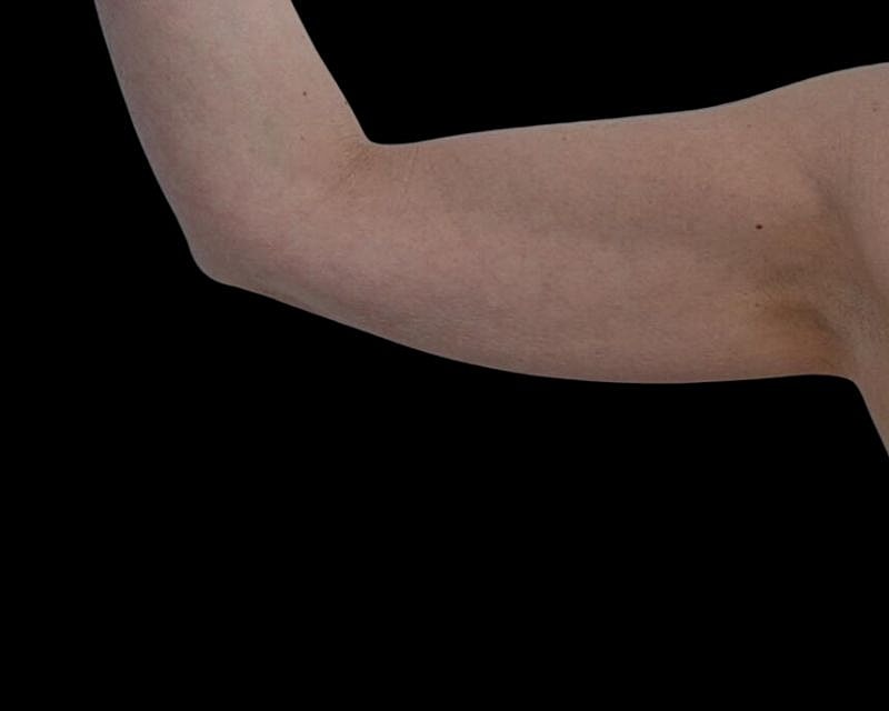 Brachioplasty Before & After