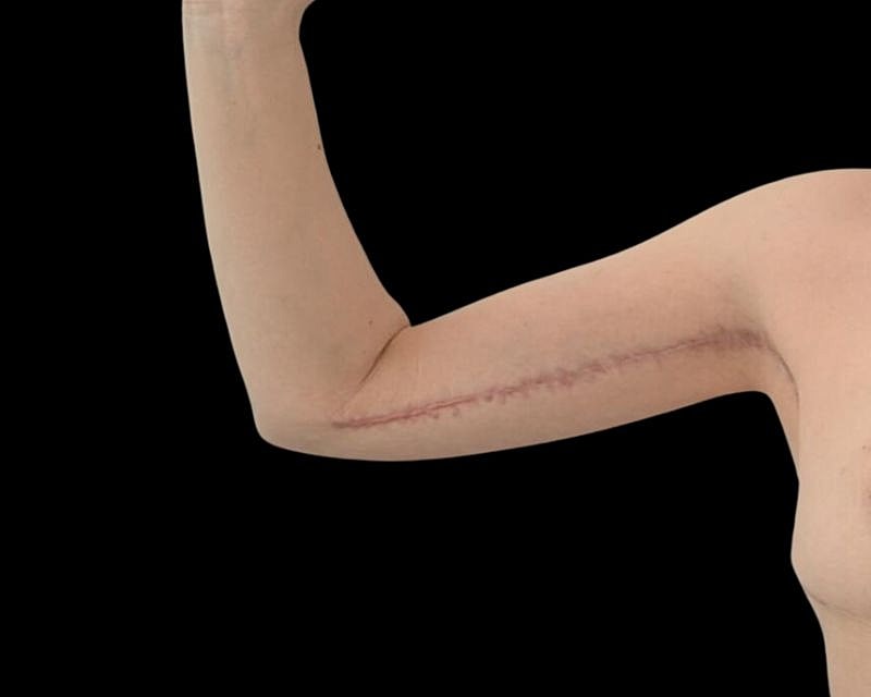 Brachioplasty Before & After