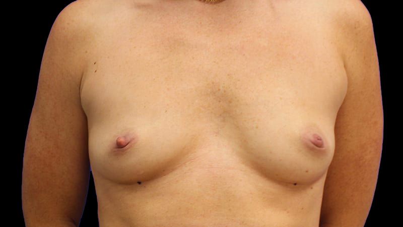 Breast Augmentation Before & After