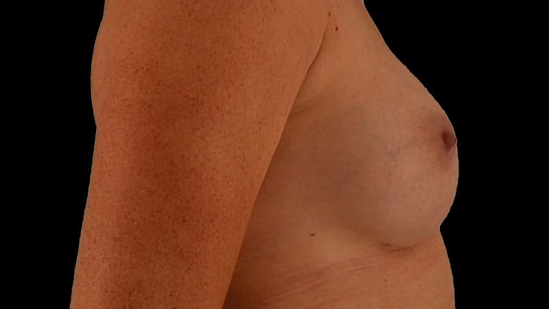 Breast Augmentation Before & After