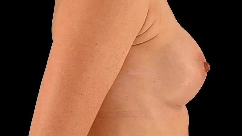 Breast Augmentation Before & After