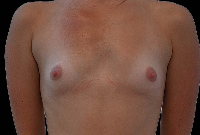 Breast Augmentation Before & After