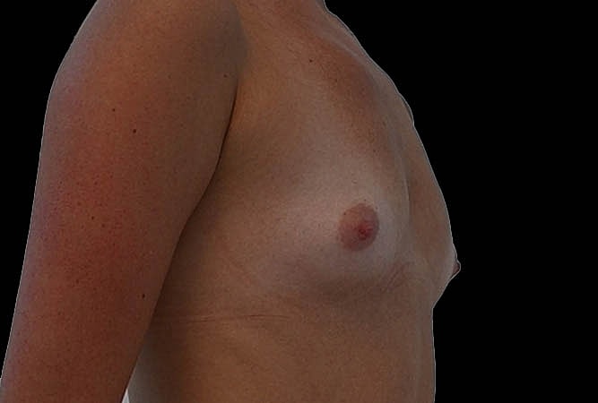 Breast Augmentation Before & After
