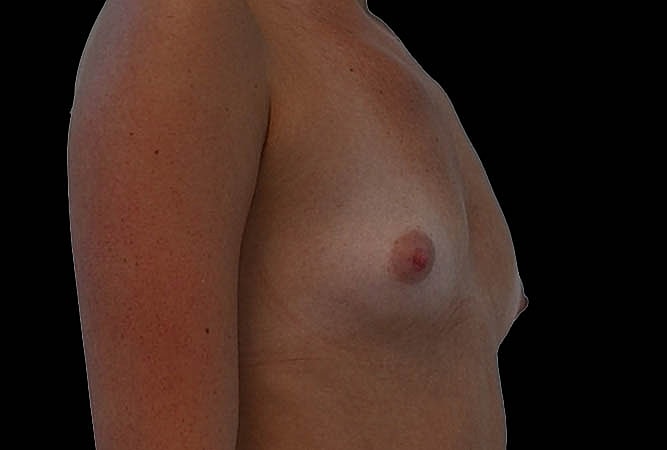 Breast Augmentation Before & After
