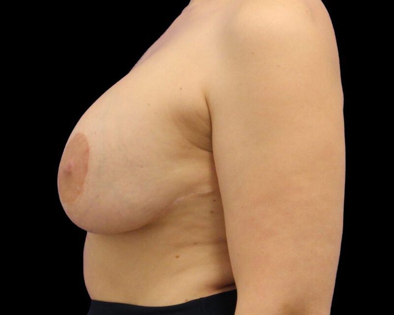 Explant With Mastopexy Before & After