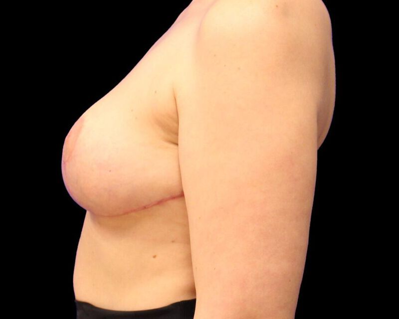 Explant With Mastopexy Before & After