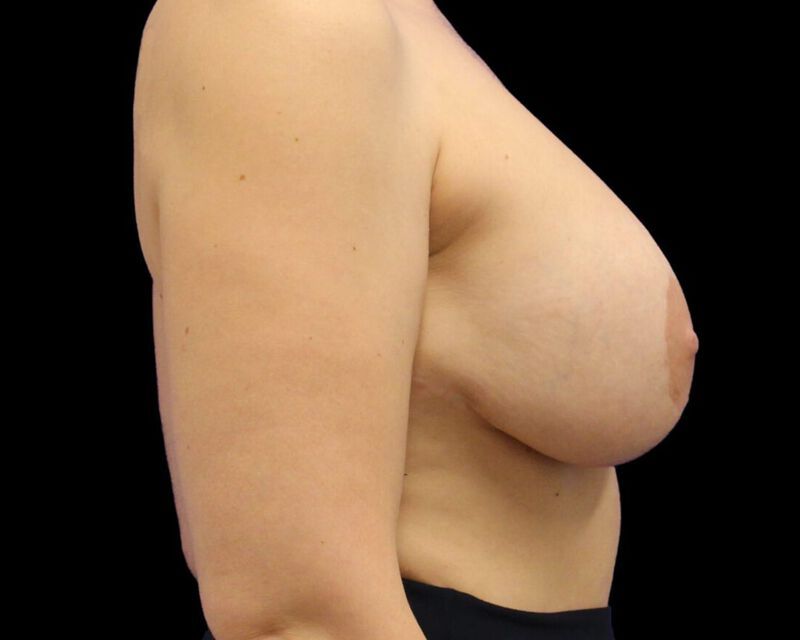 Explant With Mastopexy Before & After