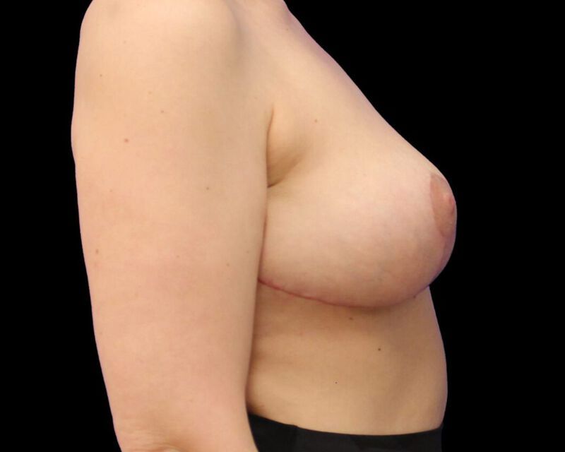 Explant With Mastopexy Before & After