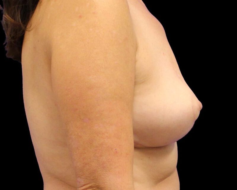 Explant With Mastopexy Before & After
