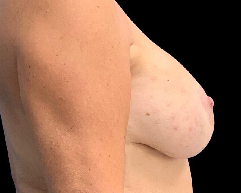 Explant With Mastopexy Before & After