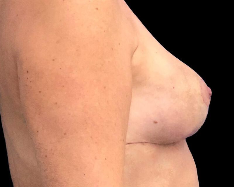 Explant With Mastopexy Before & After
